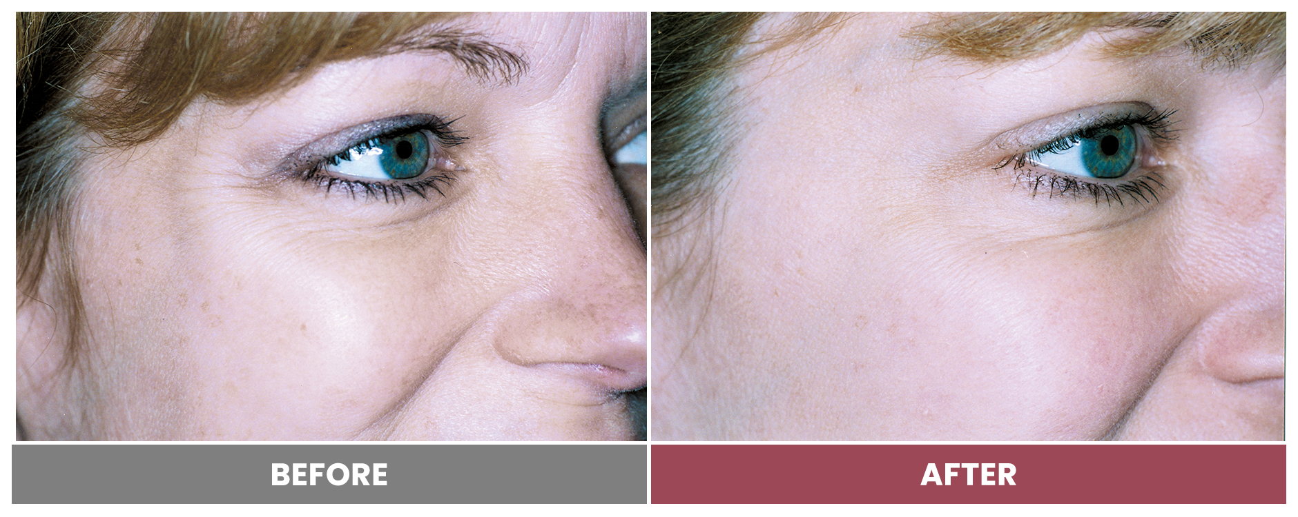 BOTOX FOR WRINKLES & BROW LIFT - Case 20
